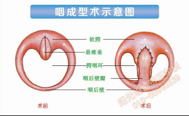 咽成型術示意圖