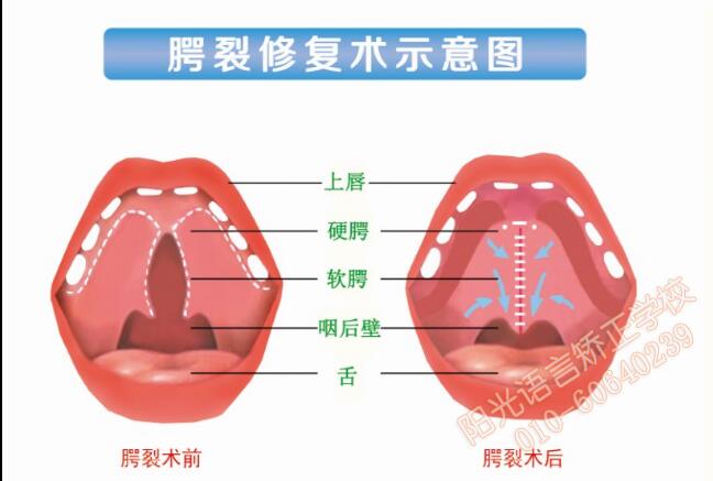 腭裂修復(fù)術(shù)示意圖